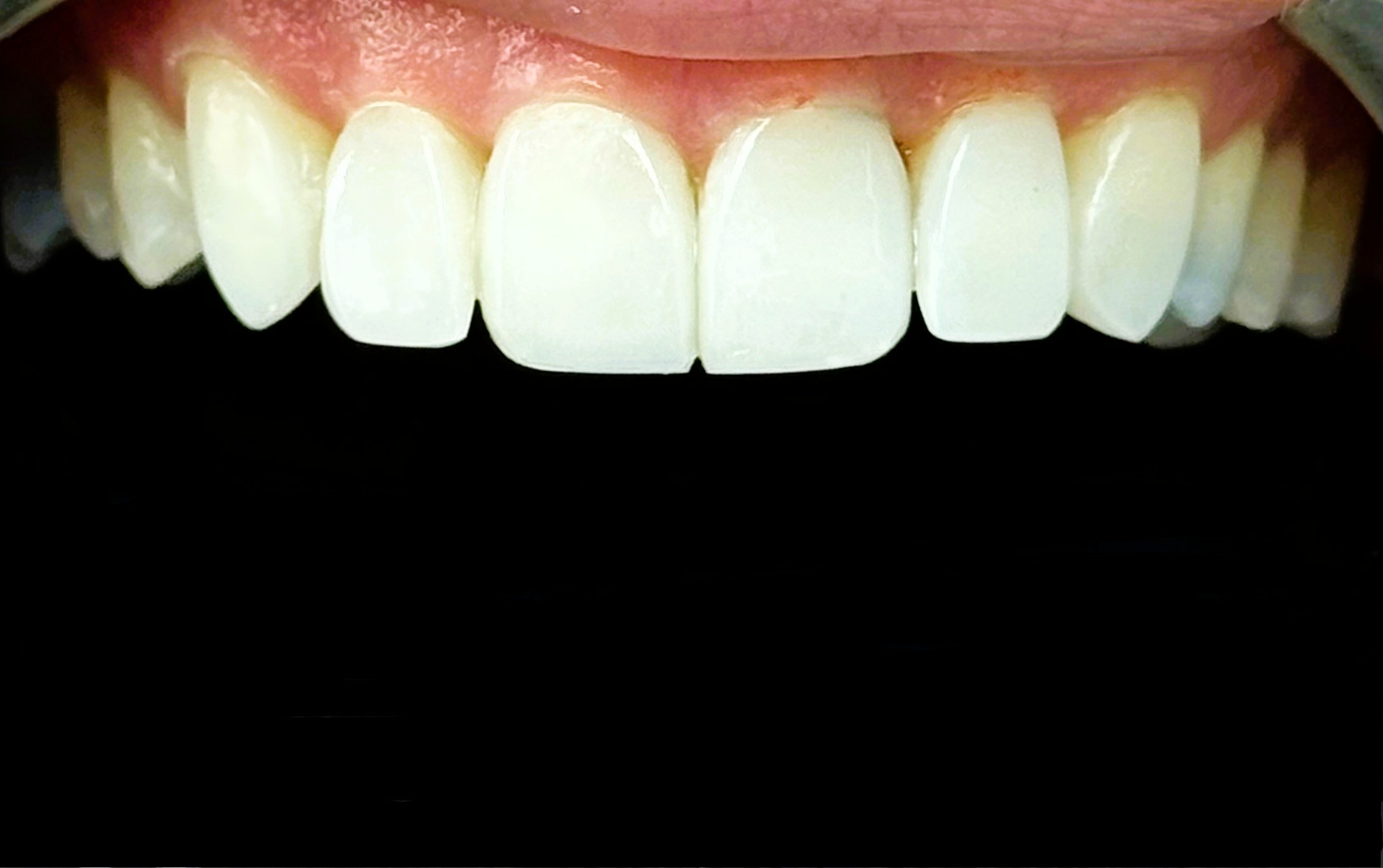 After Invisalign case 2