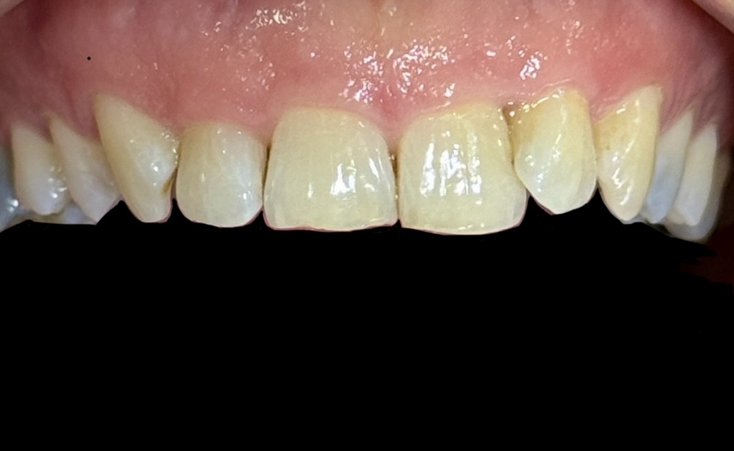 Before Invisalign case 2