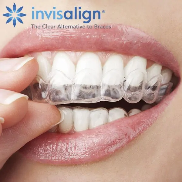 How Invisalign works